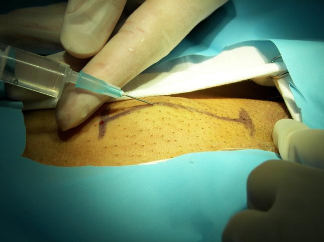 两种非手术治疗鞘膜积液的方法