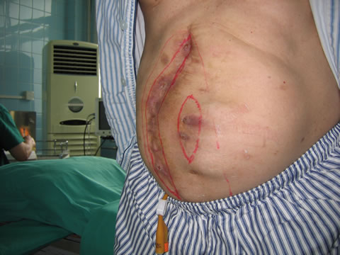 腹壁切口疝修复术