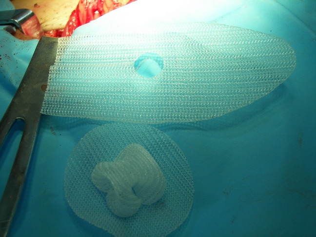 为什么要使用人工合成材料做疝修补手术？其特点是什么？